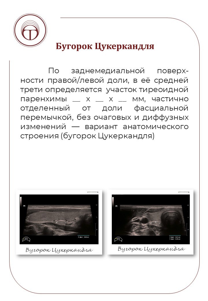 Бугорок Цукеркандля
